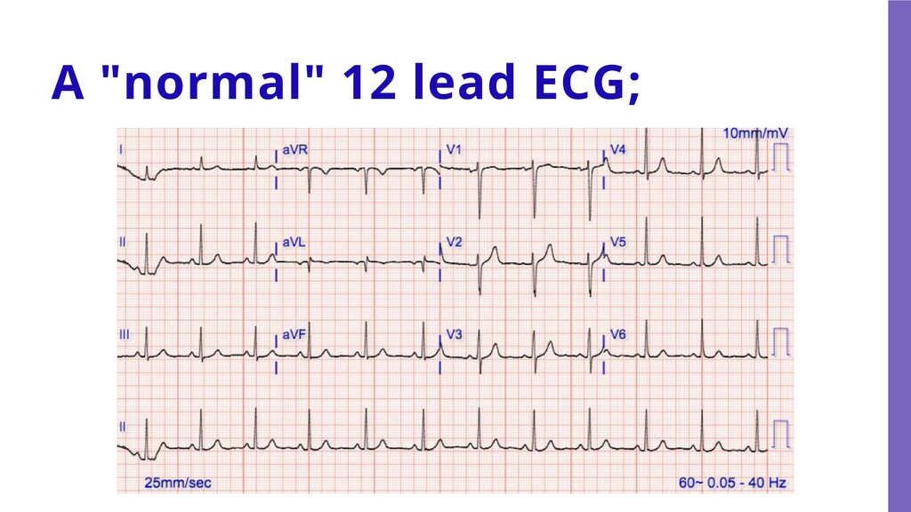The Essentials Of 12 lead ECG Rhythm Recognition Speaker Deck