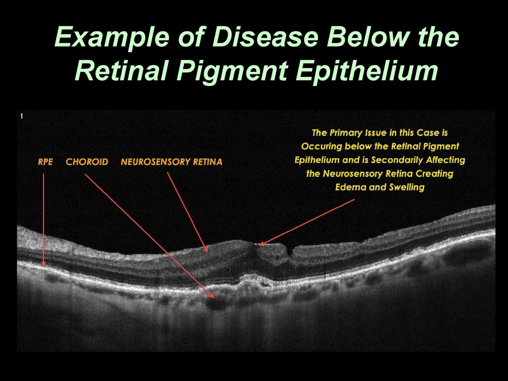 pigmented layer of retina
