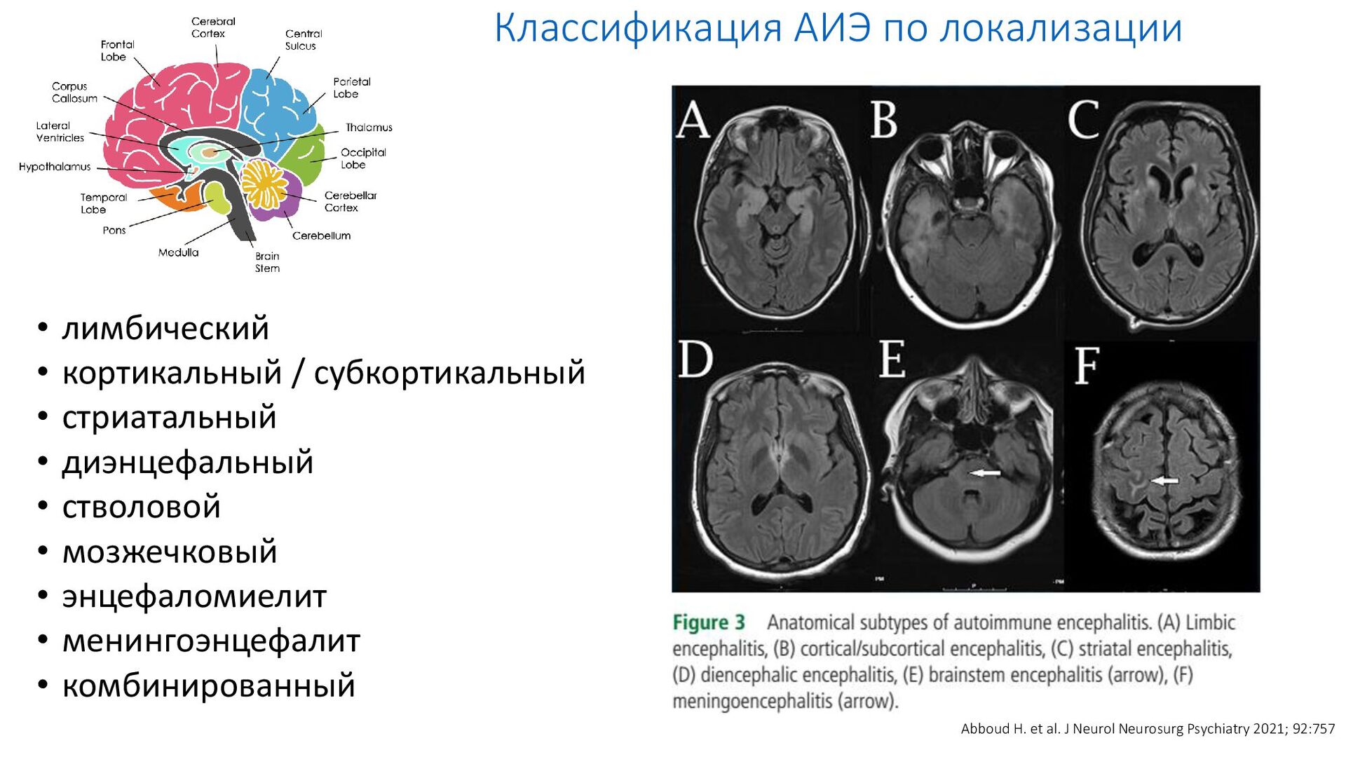 Диэнцефальная дисфункция головного мозга. Классификация менингоэнцефалита. Стволовой энцефаломиелит. Кортикально и субкортикально. Субкортикальный лейкоареоз.