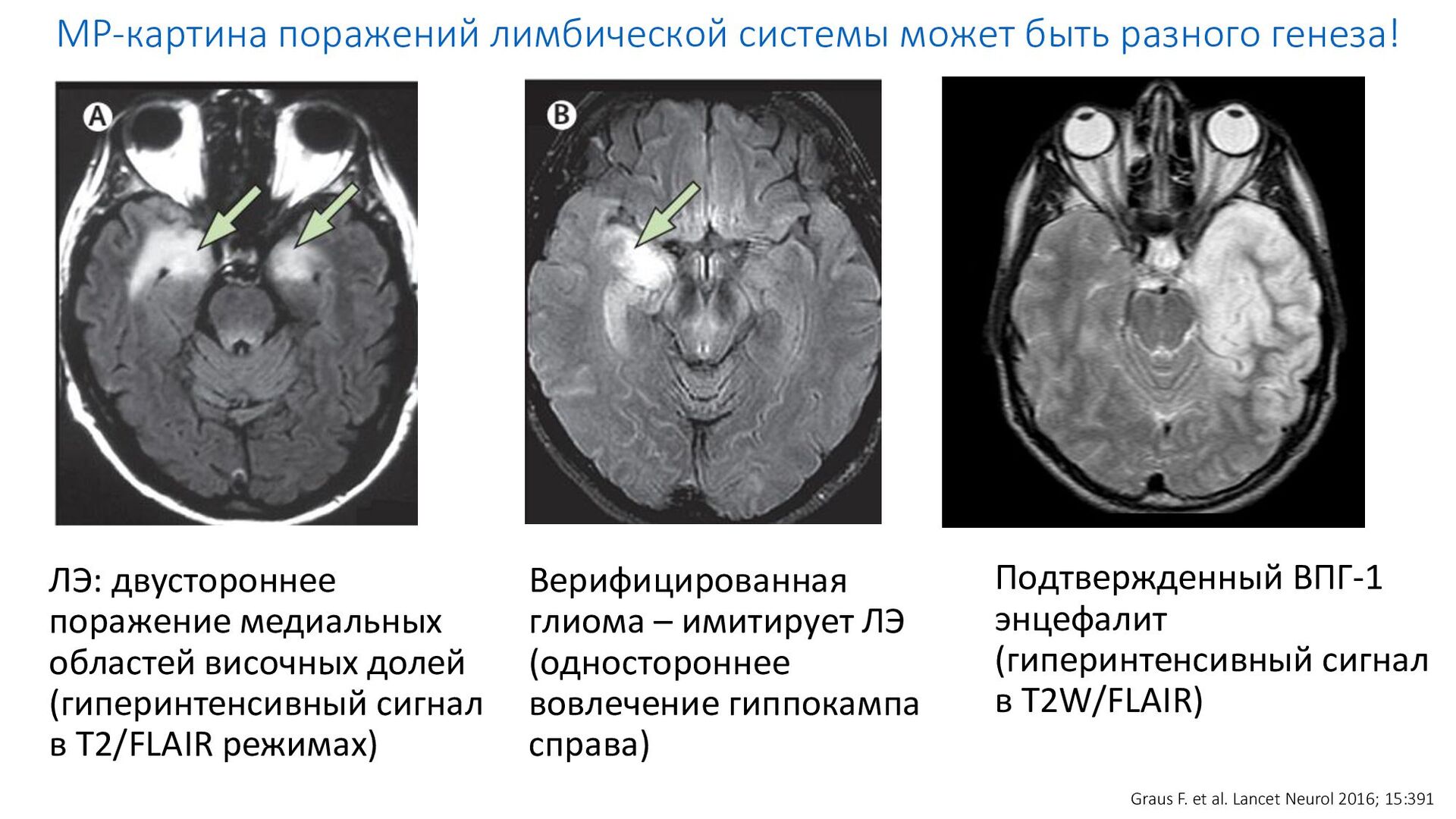 Мр картина полисинусита