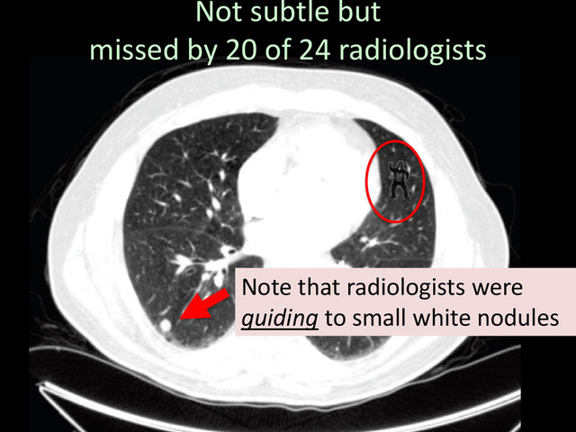 Not subtle but
missed by 20 of 24 radiologists
Note that radiologists were
guiding to small white nodules
