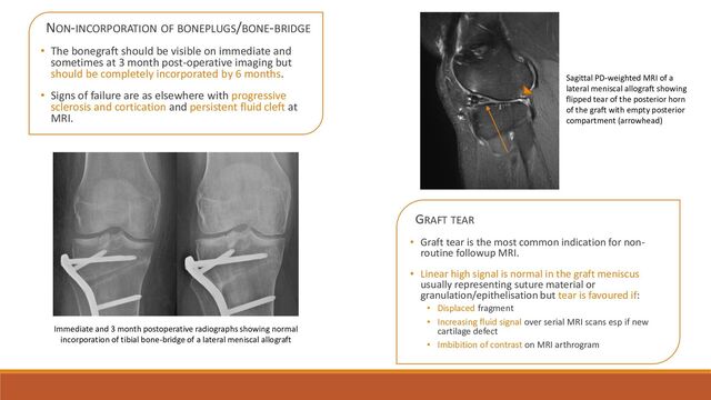 NON-INCORPORATION OF BONEPLUGS/BONE-BRIDGE
• The bonegraft should be visible on immediate and
sometimes at 3 month post-operative imaging but
should be completely incorporated by 6 months.
• Signs of failure are as elsewhere with progressive
sclerosis and cortication and persistent fluid cleft at
MRI.
GRAFT TEAR
• Graft tear is the most common indication for non-
routine followup MRI.
• Linear high signal is normal in the graft meniscus
usually representing suture material or
granulation/epithelisation but tear is favoured if:
• Displaced fragment
• Increasing fluid signal over serial MRI scans esp if new
cartilage defect
• Imbibition of contrast on MRI arthrogram
Sagittal PD-weighted MRI of a
lateral meniscal allograft showing
flipped tear of the posterior horn
of the graft with empty posterior
compartment (arrowhead)
Immediate and 3 month postoperative radiographs showing normal
incorporation of tibial bone-bridge of a lateral meniscal allograft
