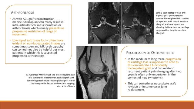 ARTHROFIBROSIS
• As with ACL graft reconstruction,
meniscus transplant can rarely result in
intra-articular scar mass formation or
arthrofibrosis which usually presents as
progressive restriction of range of
movement.
• Low signal soft tissue foci – often more
evident on non-fat-saturated images are
sometimes seen and MRI arthrography
can sometimes also be helpful but most
patients in which this is suspected
progress to arthroscopy.
PROGRESSION OF OSTEOARTHRITIS
• In the medium to long term, progression
of cartilage loss is important to note as
this can indicate a functionally
incompetent graft and can relate to
recurrent patient pain (imaging after two
years is often only undertaken in the
context of new symptoms).
• This can sometimes necessitate graft
revision or in some cases joint
replacement.
Left: 1 year postoperative and
Right: 3 year postoperative
coronal PD-weighted MRI studies
of a patient with lateral meniscal
allograft and new symptoms
showing definite interval cartilage
degeneration despite meniscal
allograft
T1-weighted MRI through the intercondylar notch
of a patient with lateral meniscal allograft with
bone-bridge technique showing low signal scar in
the infrapatellar fatpad and notch in keeping
with arthrofibrosis
