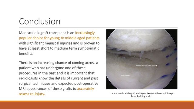 Conclusion
Meniscal allograft transplant is an increasingly
popular choice for young to middle aged patients
with significant meniscal injuries and is proven to
have at least short to medium term symptomatic
benefits.
There is an increasing chance of coming across a
patient who has undergone one of these
procedures in the past and it is important that
radiologists know the details of current and past
surgical techniques and expected post-operative
MRI appearances of these grafts to accurately
assess re-injury. Lateral meniscal allograft in situ postfixation arthroscopic image
From Spalding et al.12
