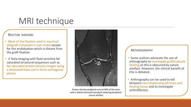 MRI technique
ROUTINE IMAGING
• Most of the fixation used in meniscal
allograft transplant is non-metal except
for the endobutton which is distant from
the graft fixation
• 3 Tesla imaging with fluid sensitive fat
saturated structural sequences such as
fat-saturated proton-density images using
a dedicated knee coil in three orthogonal
planes
Proton-density weighted coronal MRI of the knee
with a lateral meniscal transplant showing peripheral
suture artefact
ARTHROGRAPHY
• Some authors advocate the use of
arthrography to investigate graft/capsule
healing as this is obscured by suture
artefact. However, the clinical benefit of
this is debated.
• Arthrography can be used to tell
between non-displaced graft tears and
healing tissue and to investigate
arthrofibrosis.
