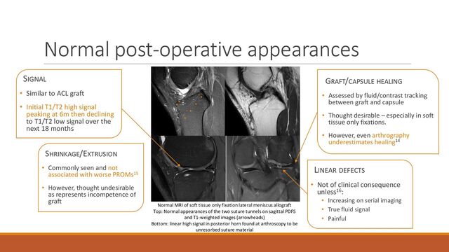 Normal post-operative appearances
SIGNAL
• Similar to ACL graft
• Initial T1/T2 high signal
peaking at 6m then declining
to T1/T2 low signal over the
next 18 months
SHRINKAGE/EXTRUSION
• Commonly seen and not
associated with worse PROMs15
• However, thought undesirable
as represents incompetence of
graft
GRAFT/CAPSULE HEALING
• Assessed by fluid/contrast tracking
between graft and capsule
• Thought desirable – especially in soft
tissue only fixations.
• However, even arthrography
underestimates healing14
LINEAR DEFECTS
• Not of clinical consequence
unless16:
• Increasing on serial imaging
• True fluid signal
• Painful
Normal MRI of soft tissue only fixation lateral meniscus allograft
Top: Normal appearances of the two suture tunnels on sagittal PDFS
and T1-weighted images (arrowheads)
Bottom: linear high signal in posterior horn found at arthroscopy to be
unresorbed suture material
