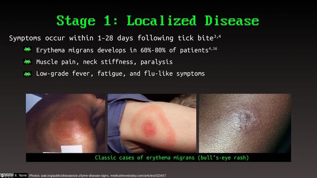 Stage 1: Localized Disease
Symptoms occur within 1–28 days following tick bite3,4
– Erythema migrans develops in 60%-80% of patients4,16
– Muscle pain, neck stiffness, paralysis
– Low-grade fever, fatigue, and flu-like symptoms
Photos: aad.org/public/diseases/a-z/lyme-disease-signs, medicalnewstoday.com/articles/323457
Classic cases of erythema migrans (bull’s-eye rash)
