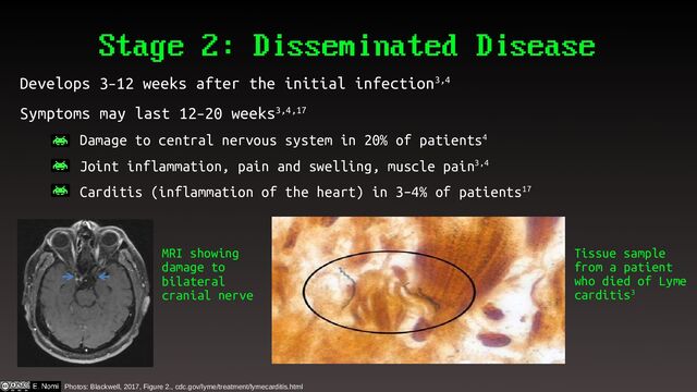 Stage 2: Disseminated Disease
Develops 3–12 weeks after the initial infection3,4
Symptoms may last 12–20 weeks3,4,17
– Damage to central nervous system in 20% of patients4
– Joint inflammation, pain and swelling, muscle pain3,4
– Carditis (inflammation of the heart) in 3–4% of patients17
MRI showing
damage to
bilateral
cranial nerve
Tissue sample
from a patient
who died of Lyme
carditis3
Photos: Blackwell, 2017, Figure 2., cdc.gov/lyme/treatment/lymecarditis.html
