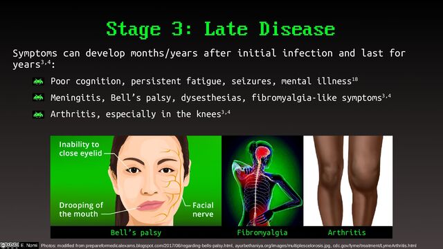 Stage 3: Late Disease
Symptoms can develop months/years after initial infection and last for
years3,4:
– Poor cognition, persistent fatigue, seizures, mental illness18
– Meningitis, Bell’s palsy, dysesthesias, fibromyalgia-like symptoms3,4
– Arthritis, especially in the knees3,4
Photos: modified from prepareformedicalexams.blogspot.com/2017/06/regarding-bells-palsy.html, ayurbethaniya.org/images/multiplescelorosis.jpg, cdc.gov/lyme/treatment/LymeArthritis.html
Bell’s palsy Arthritis
Fibromyalgia
