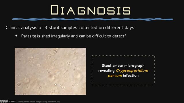 Clinical analysis of 3 stool samples collected on different days
● Parasite is shed irregularly and can be difficult to detect8
Diagnosis
Stool smear micrograph
revealing Cryptosporidium
parvum infection
Photo: Public Health Image Library on wikidoc.org
