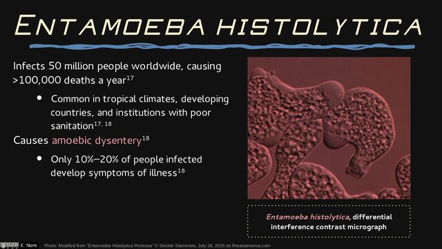 Infects 50 million people worldwide, causing
>100,000 deaths a year17
● Common in tropical climates, developing
countries, and institutions with poor
sanitation17, 18
Causes amoebic dysentery18
● Only 10%–20% of people infected
develop symptoms of illness18
Photo: Modified from “Entamoeba Histolytica Protozoa” © Sinclair Stammers, July 28, 2016 on fineartamerica.com
Entamoeba histolytica
Entamoeba histolytica, differential
interference contrast micrograph
