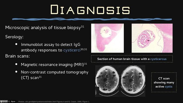 Microscopic analysis of tissue biopsy31
Serology:
● Immunoblot assay to detect IgG
antibody responses to cysticerci30,31
Brain scans:
● Magnetic resonance imaging (MRI)31
● Non-contrast computed tomography
(CT) scan31
Photos: cdc.gov/dpdx/cysticercosis/index.html Figures A and B, Carpio, 1998, Figure 1.
Diagnosis
CT scan
showing many
active cysts
Section of human brain tissue with a cysticercus
