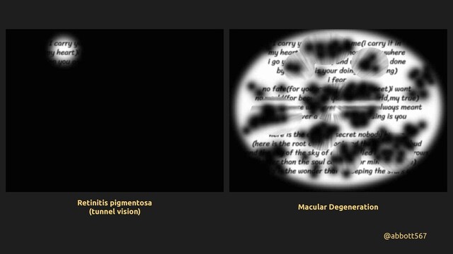 @abbott567
Retinitis pigmentosa
(tunnel vision)
Macular Degeneration
