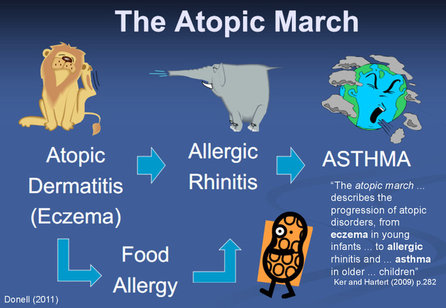 The March of Atopy
“The atopic march ...
describes the
progression of atopic
disorders, from
eczema in young
infants ... to allergic
rhinitis and ... asthma
in older ... children”
Ker and Hartert (2009) p.282
Donell (2011)
