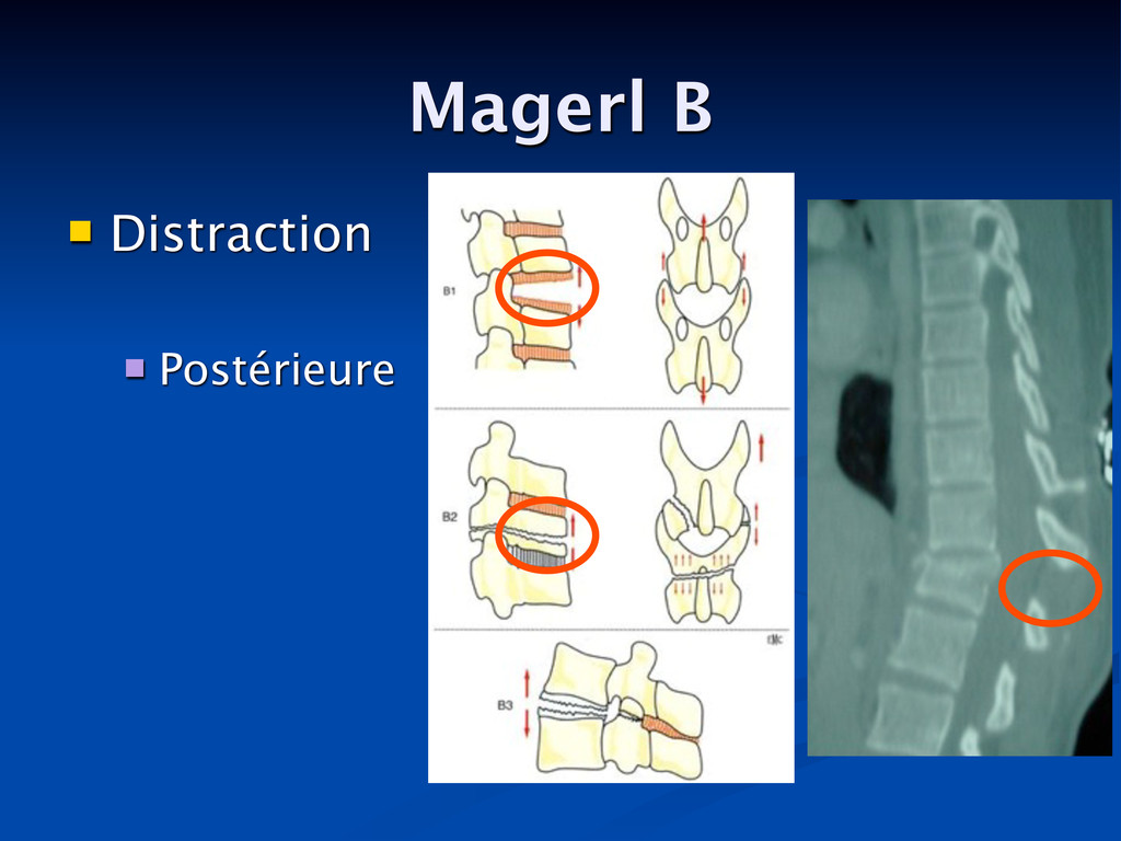 Fracture vertébrale stable et instable MA.Rousseau - Speaker Deck