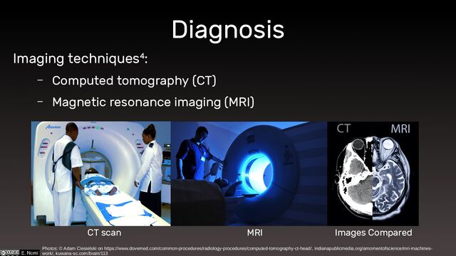 Diagnosis
Imaging techniques4:
– Computed tomography (CT)
– Magnetic resonance imaging (MRI)
Photos: © Adam Ciesielski on https://www.dovemed.com/common-procedures/radiology-procedures/computed-tomography-ct-head/, indianapublicmedia.org/amomentofscience/mri-machines-
work/, kuwana-sc.com/brain/113
CT scan MRI Images Compared
