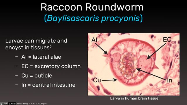 Raccoon Roundworm
(Baylisascaris procyonis)
Larvae can migrate and
encyst in tissues5
– AI = lateral alae
– EC = excretory column
– Cu = cuticle
– In = central intestine
Photo: Hung, T. et al., 2012, Figure.
Larva in human brain tissue
