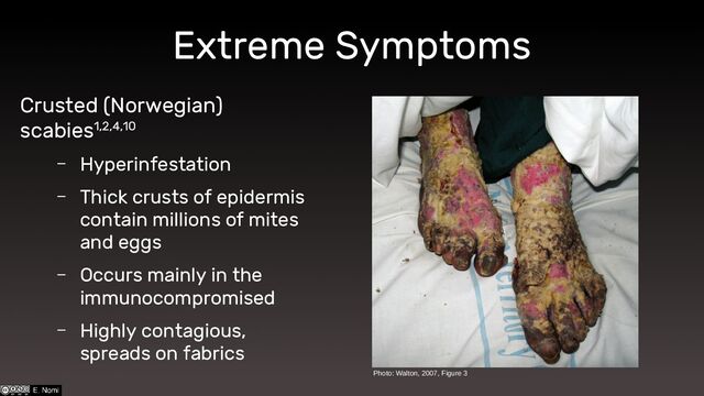 Crusted (Norwegian)
scabies1,2,4,10
– Hyperinfestation
– Thick crusts of epidermis
contain millions of mites
and eggs
– Occurs mainly in the
immunocompromised
– Highly contagious,
spreads on fabrics
Extreme Symptoms
Photo: Walton, 2007, Figure 3
