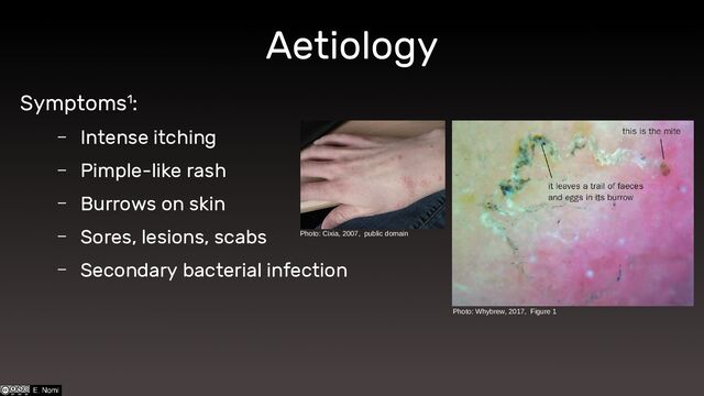 Aetiology
Symptoms1:
– Intense itching
– Pimple-like rash
– Burrows on skin
– Sores, lesions, scabs
– Secondary bacterial infection
Photo: Cixia, 2007, public domain
Photo: Whybrew, 2017, Figure 1
