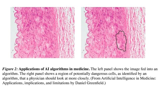 Figure 2: Applications of AI algorithms in medicine. The left panel shows the image fed into an
algorithm. The right panel shows a region of potentially dangerous cells, as identiﬁed by an
algorithm, that a physician should look at more closely. (From Artiﬁcial Intelligence in Medicine:
Applications, implications, and limitations by Daniel Greenﬁeld.)
