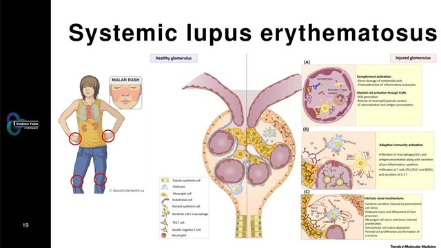 19
Systemic lupus erythematosus
